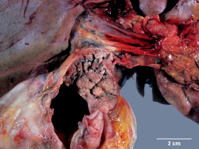 Gall bladder cystic duct carcinoma_resized2.jpg